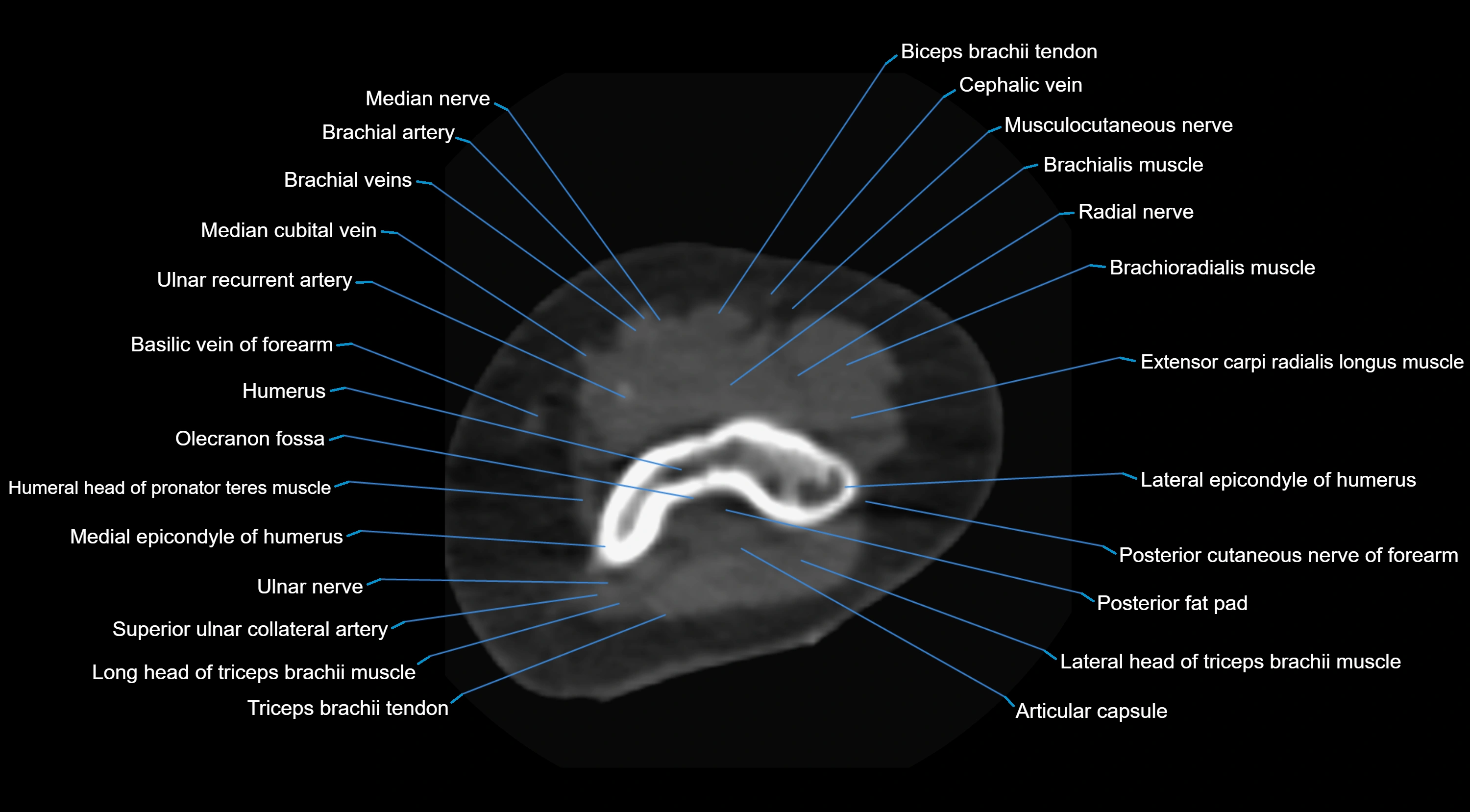 CT elbow axial  cross sectional anatomy labelled  radiology image -00013.webp